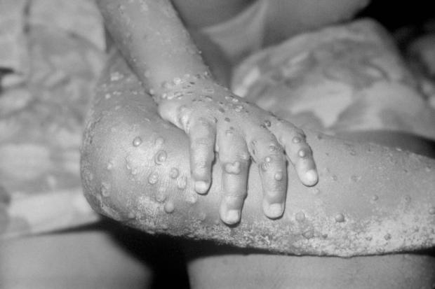 Gazette & Herald: The monkeypox virus can be spread in a number of ways. Picture: PA