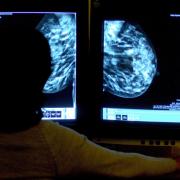 Hundreds fewer cancers were diagnosed in North Yorkshire in 2020, figures show – a year which also saw a fall in the proportion found at an early stage